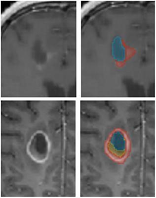 Post-operative glioblastoma multiforme segmentation with uncertainty estimation